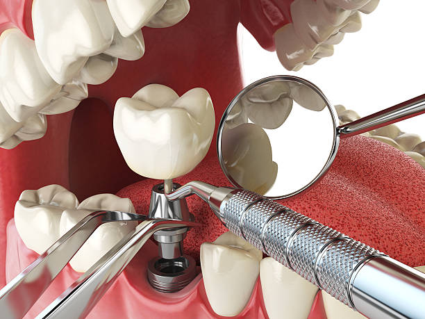 Best Emergency Dentist for Lost Fillings or Crowns in Maplewood, WA